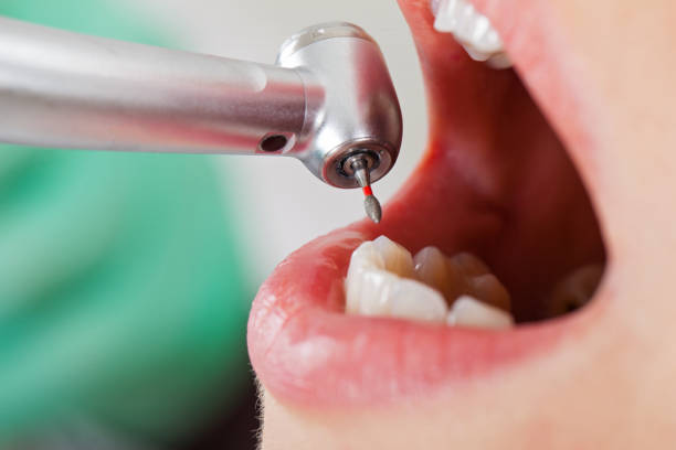 Best Emergency Tooth Extraction in Kenwood, OH
